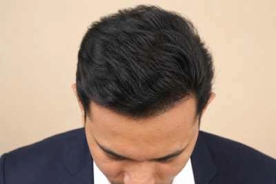 After hairline treatment