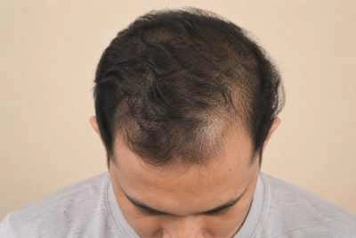 Before hairline treatment