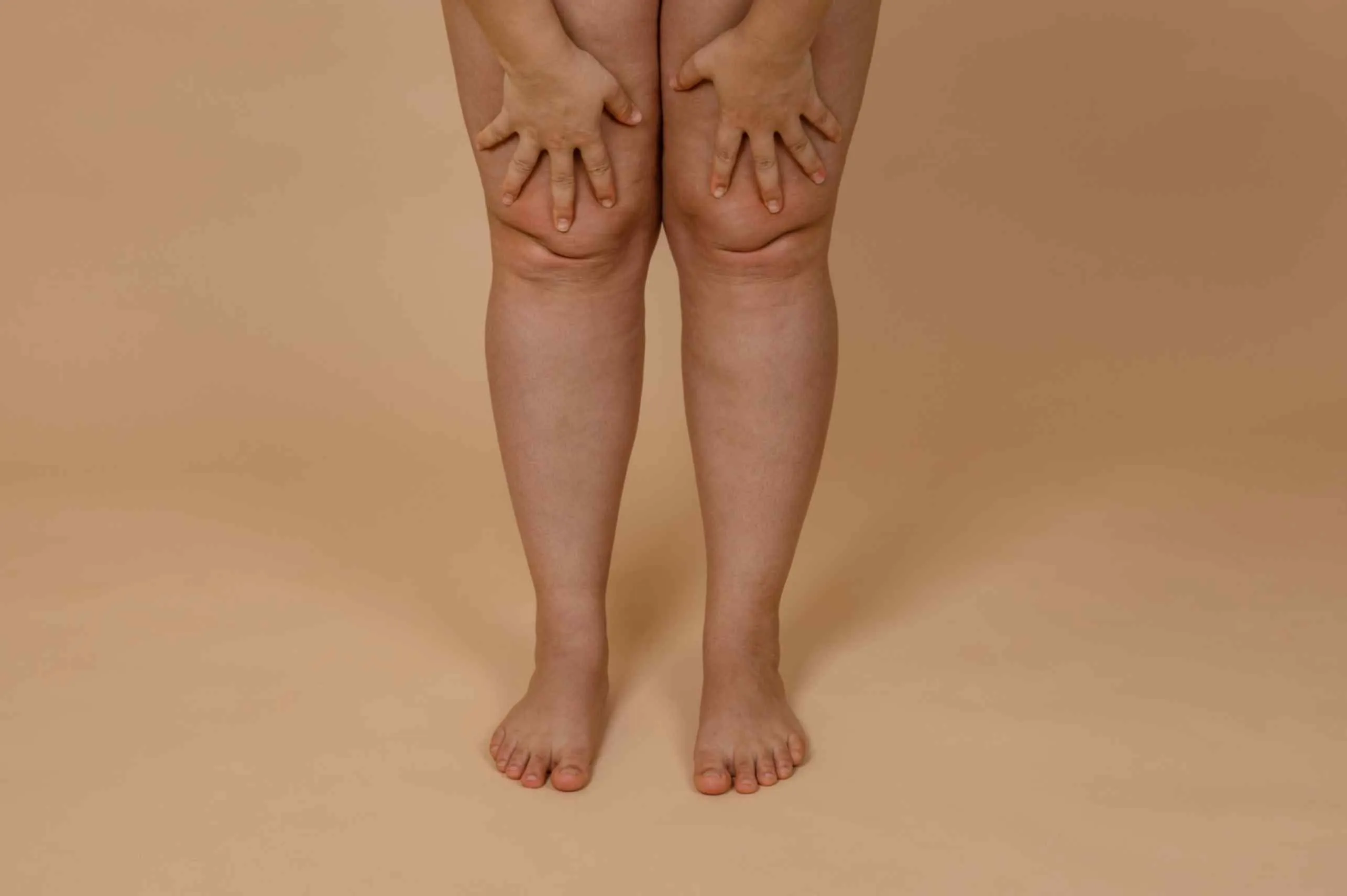 Leg Fat Loss Obesity Treatment for Men Women VLCC