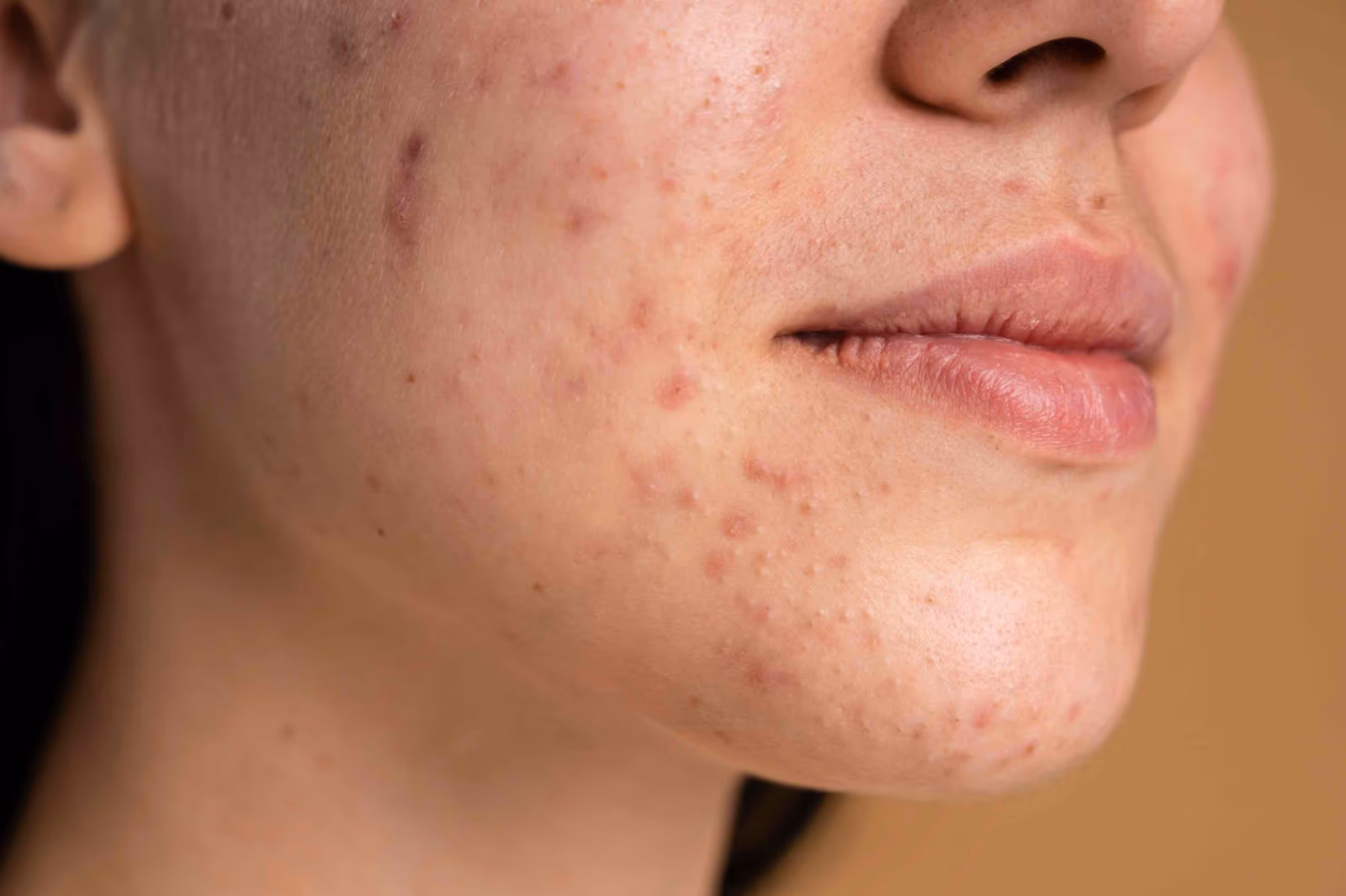 Acne & Scars