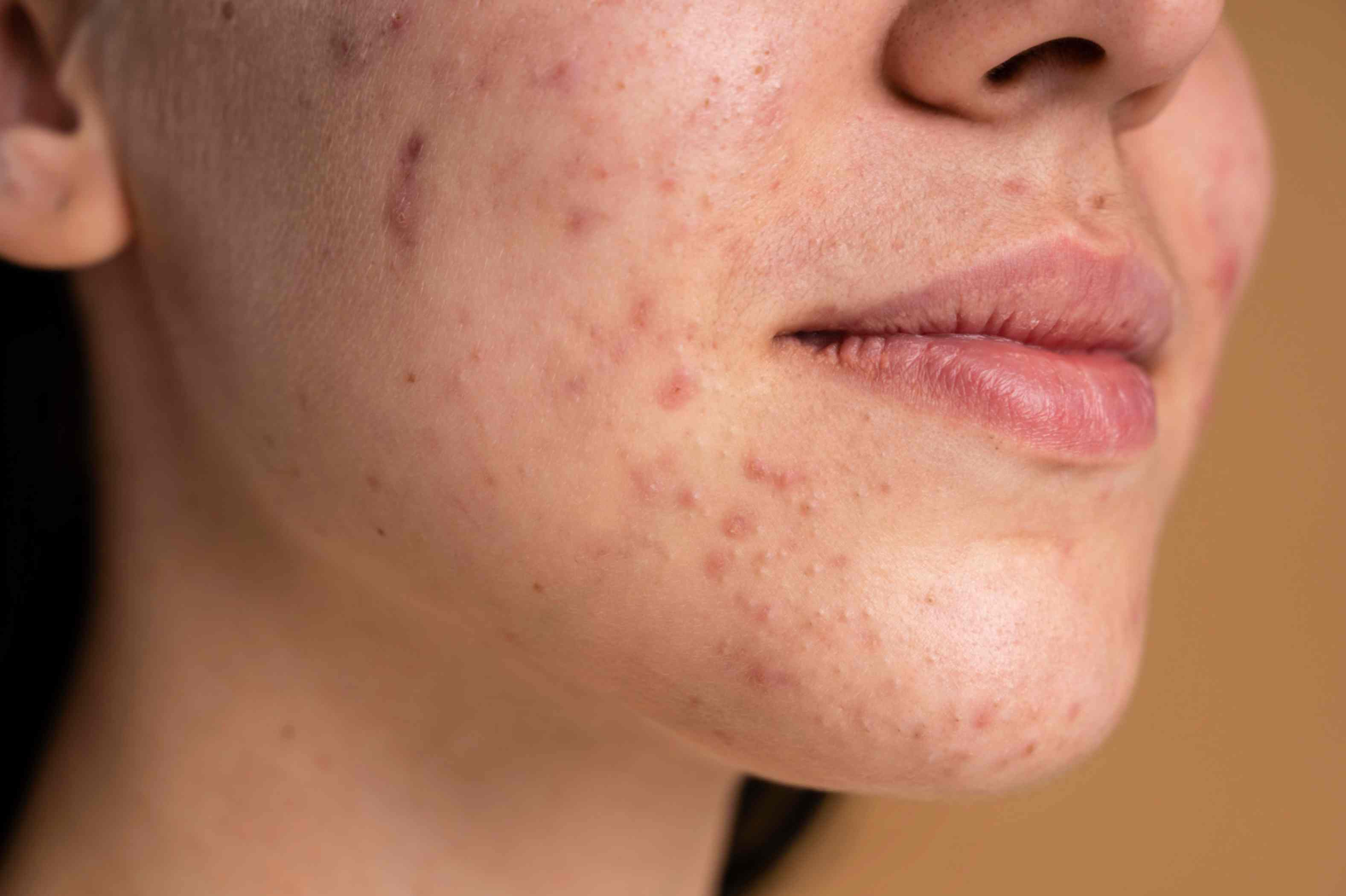 Acne & Scars