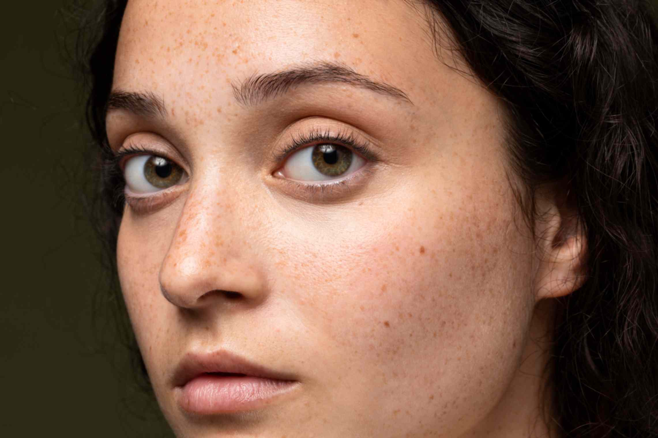 Dull/Pigmentation/Melasma