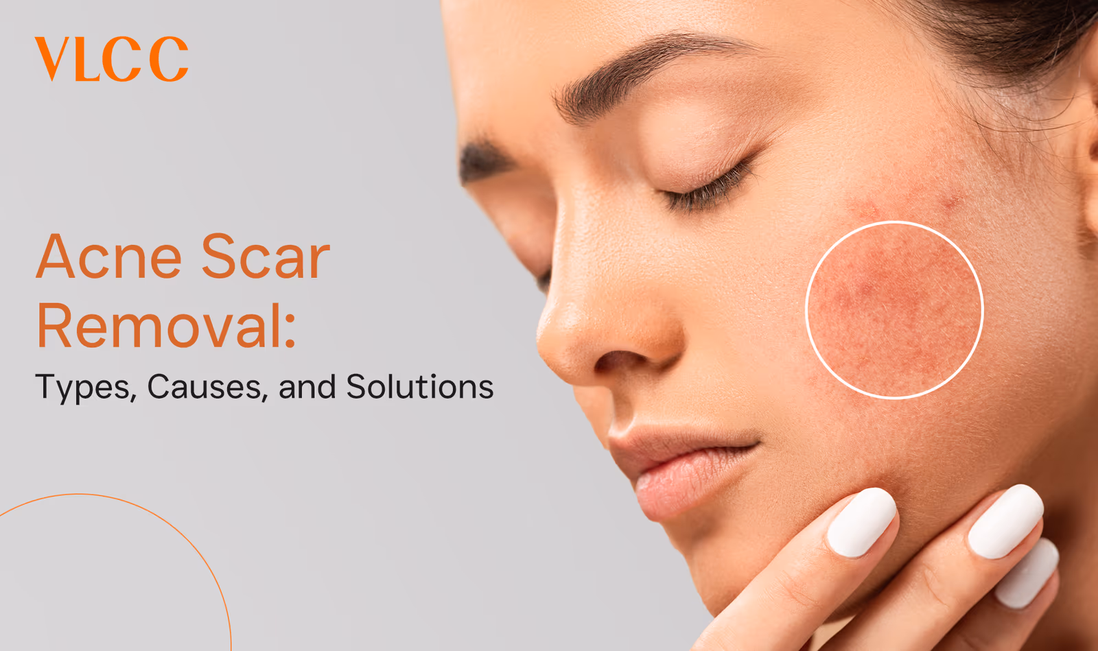 A Comprehensive Guide to Acne Scar Removal: Types, Causes, and Solutions
