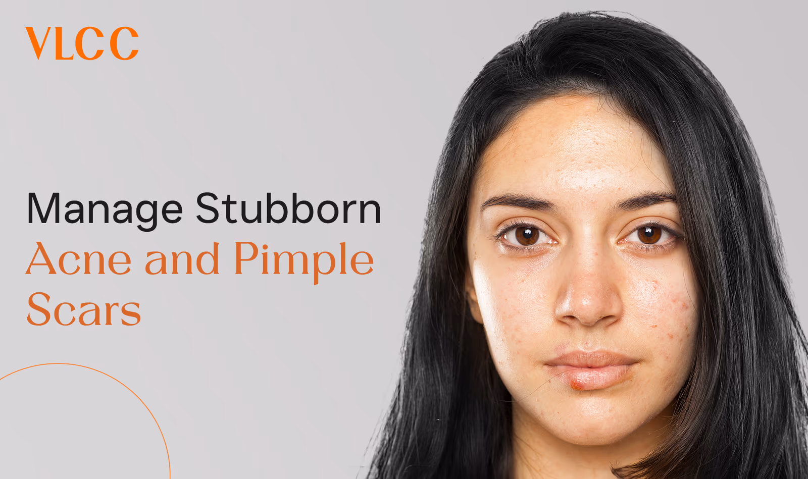 How to Manage Stubborn Acne and Pimple Scars?