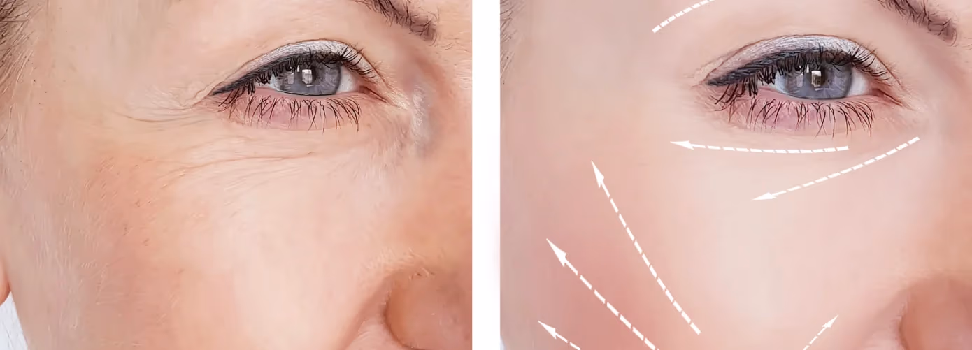 Get Rid of Wrinkles: Easy Home Remedies + Expert Treatments