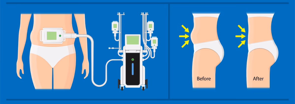 Fat Freezing in Ras Al Khaimah