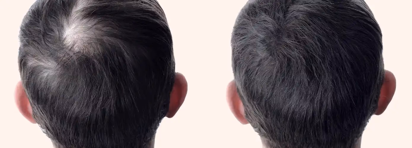 Hair Transplant in Kolkata- Cost, Benefits, and Results