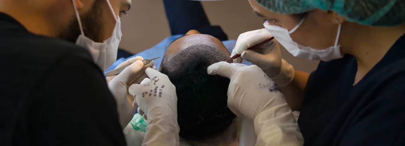 Hair Transplant in Delhi NCR: Cost, Benefits, Procedure, and Results
