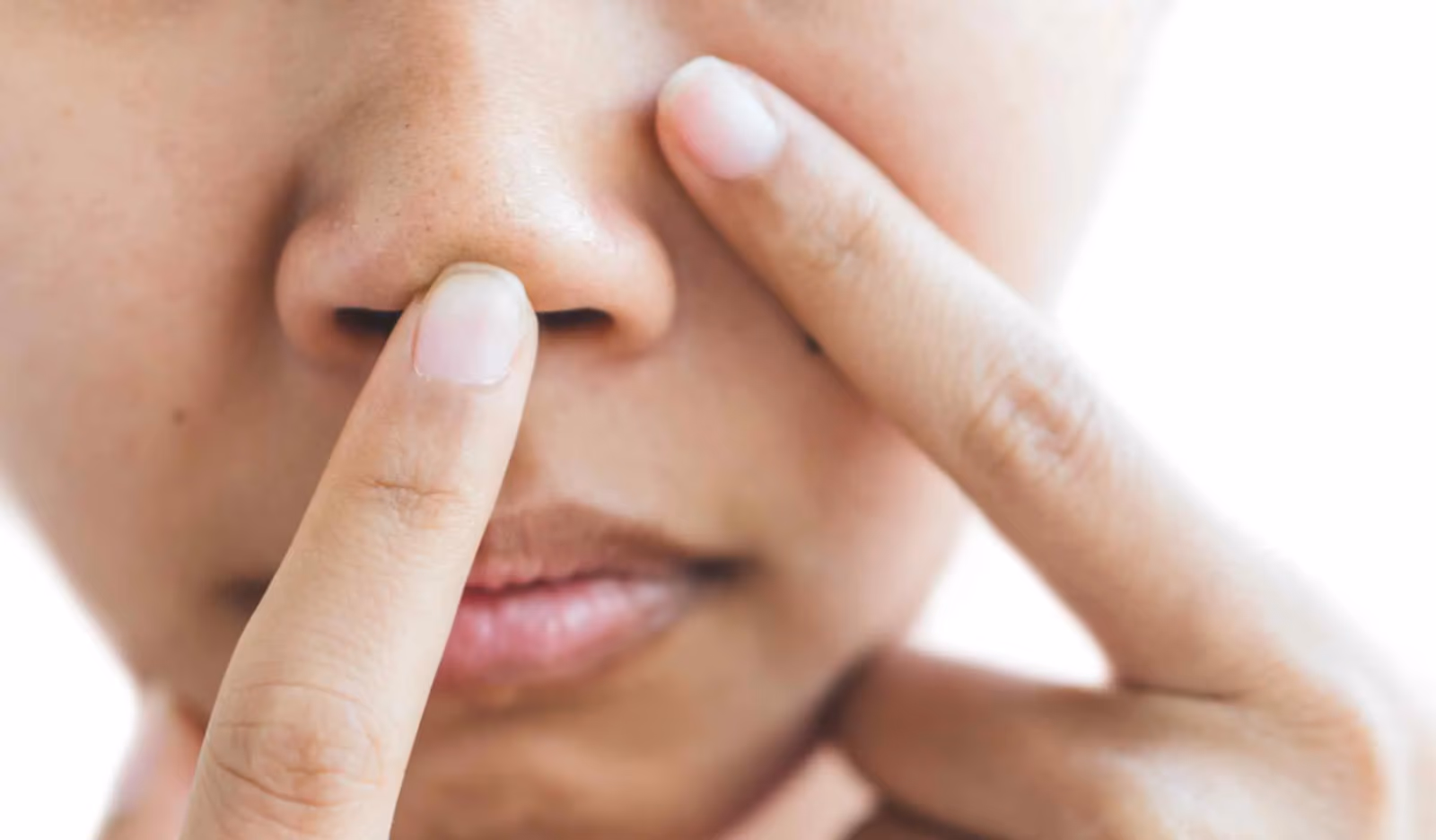 Whitehead: Treatment, Causes and Prevention