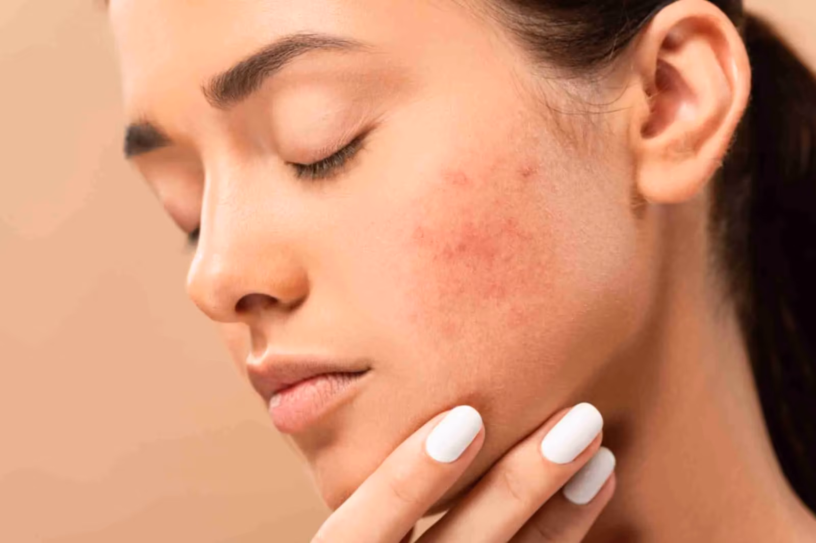 Acne Scar Treatment in Gurgaon: Factors Affecting Cost