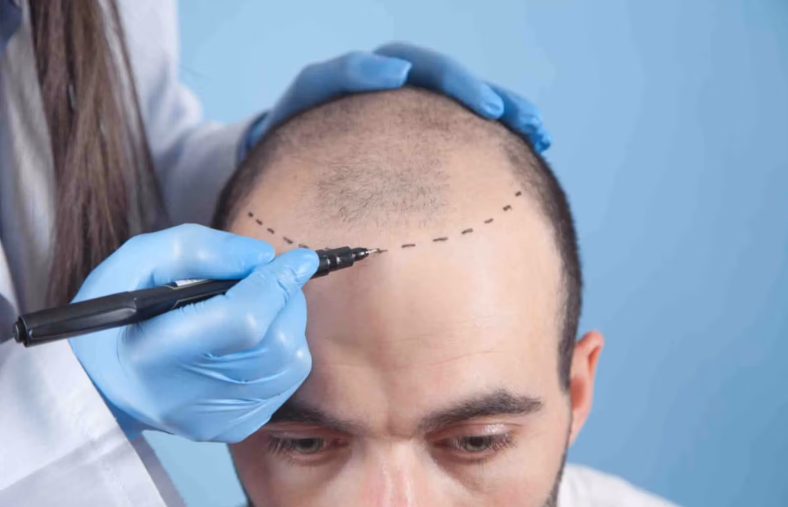 From Cost to Location: Here's What You Should Know About Hair Transplants in Gurgaon