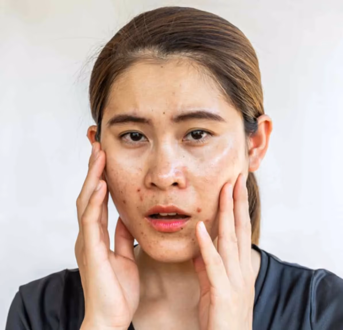 Most Effective Acne Scars Treatments in Mumbai