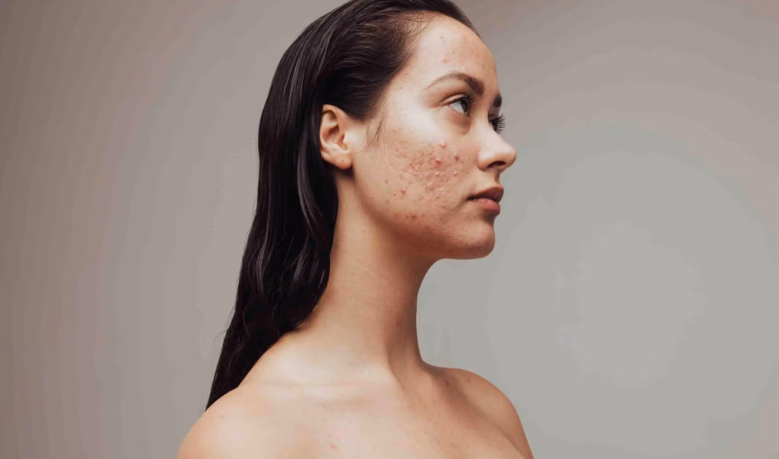 Acne Scar Treatment in Pune For Flawless Skin