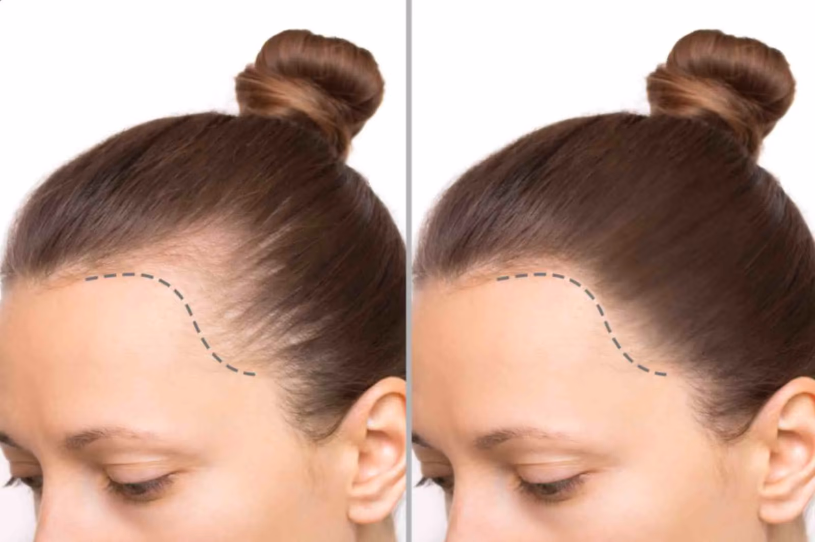 Hair Loss Treatment in Mumbai: Benefits, Procedure, and Expectations