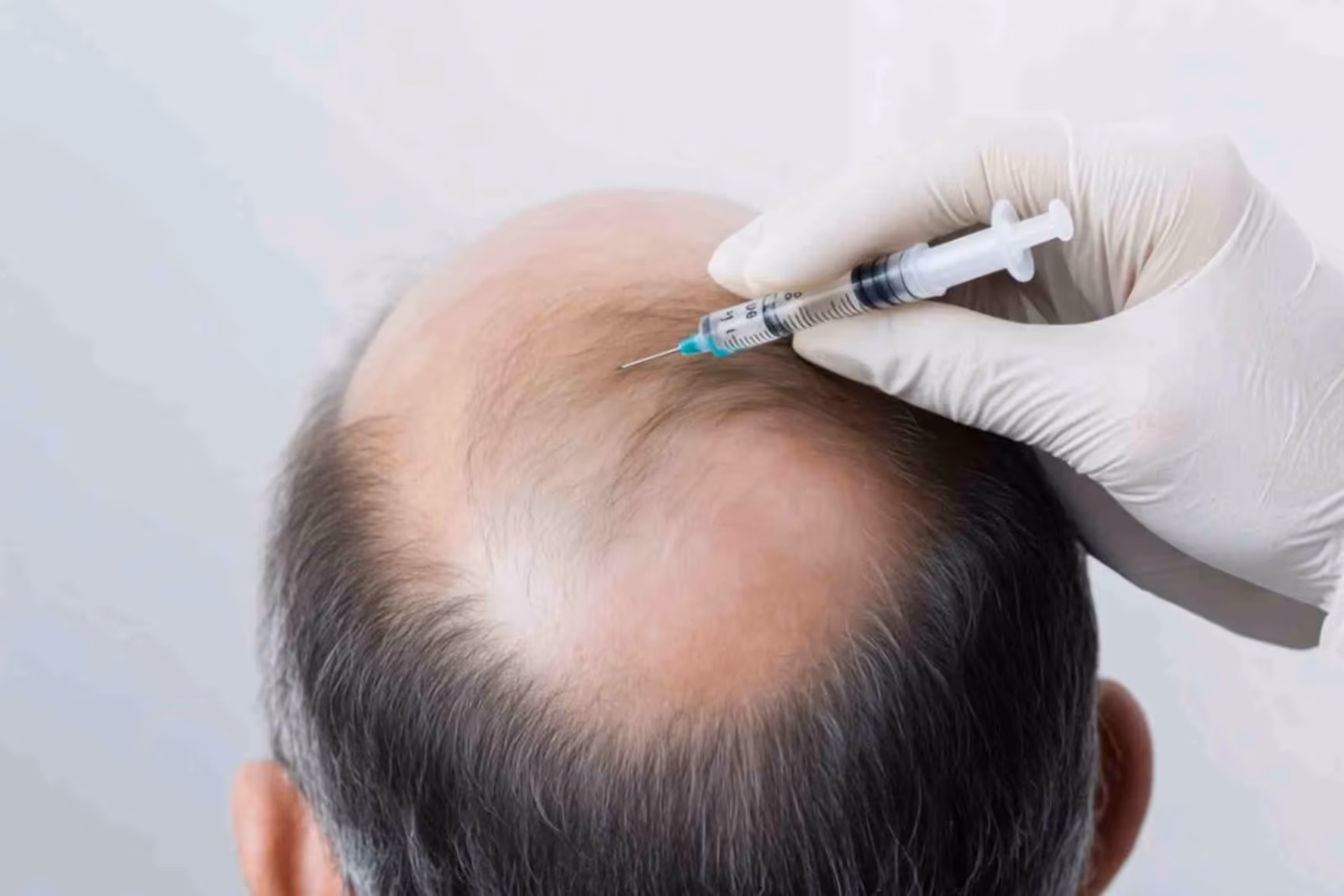 Hair Loss Treatments in Delhi: Benefits, Procedure, and What to Expect