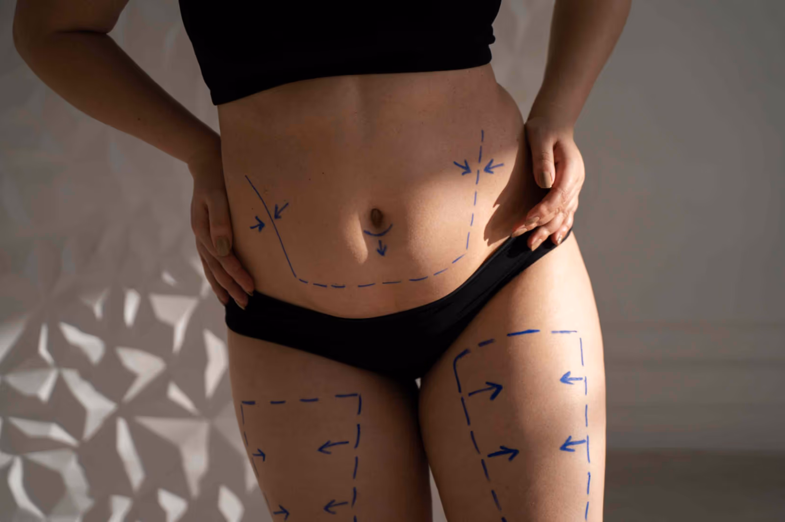 Is Bodysculpting a Good Option for Fat Reduction?