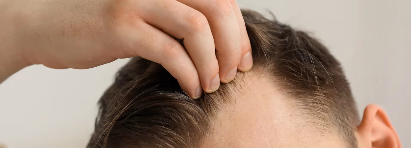 Mature Hairline vs. Receding: How to Identify & Best Treatments for Both
