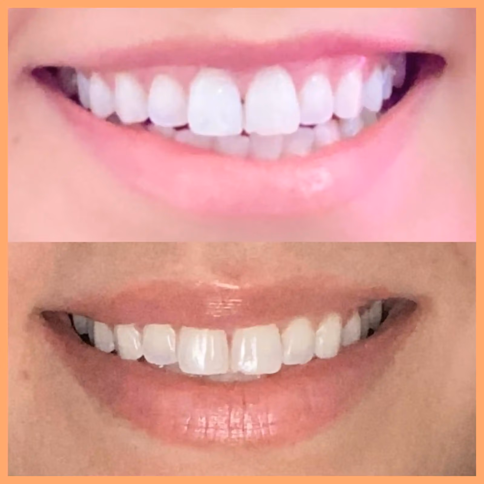 Lip Flip vs Lip Filler: Which One Will Give You the Perfect Pout?