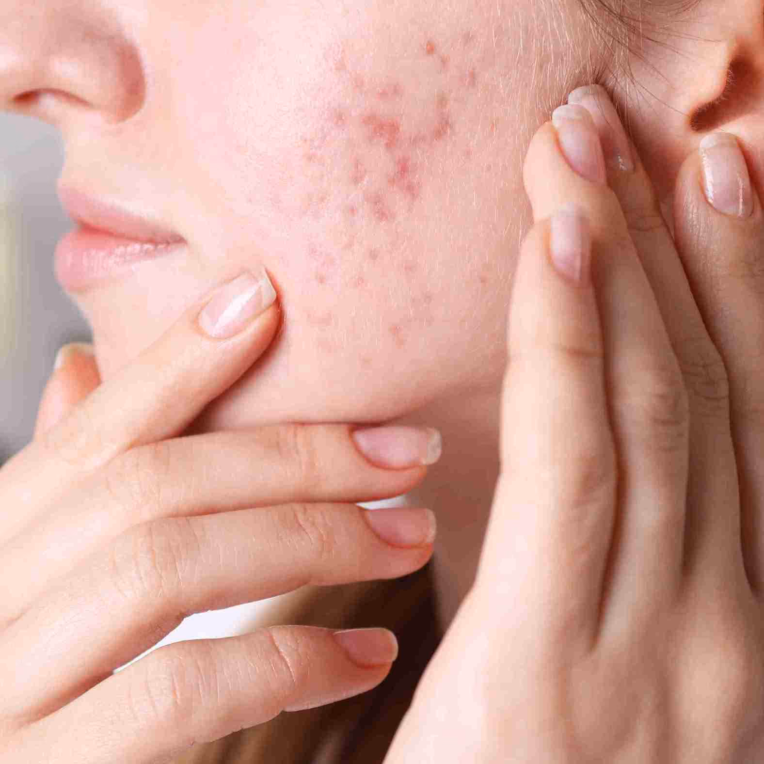 Struggling with Hormonal Acne? Here’s How HydraFacial Can Help