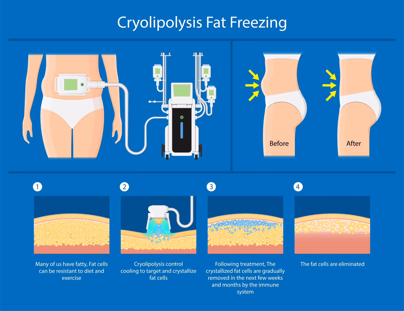 Fat Freezing in Sharjah