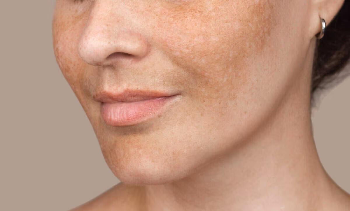 Pigmentation