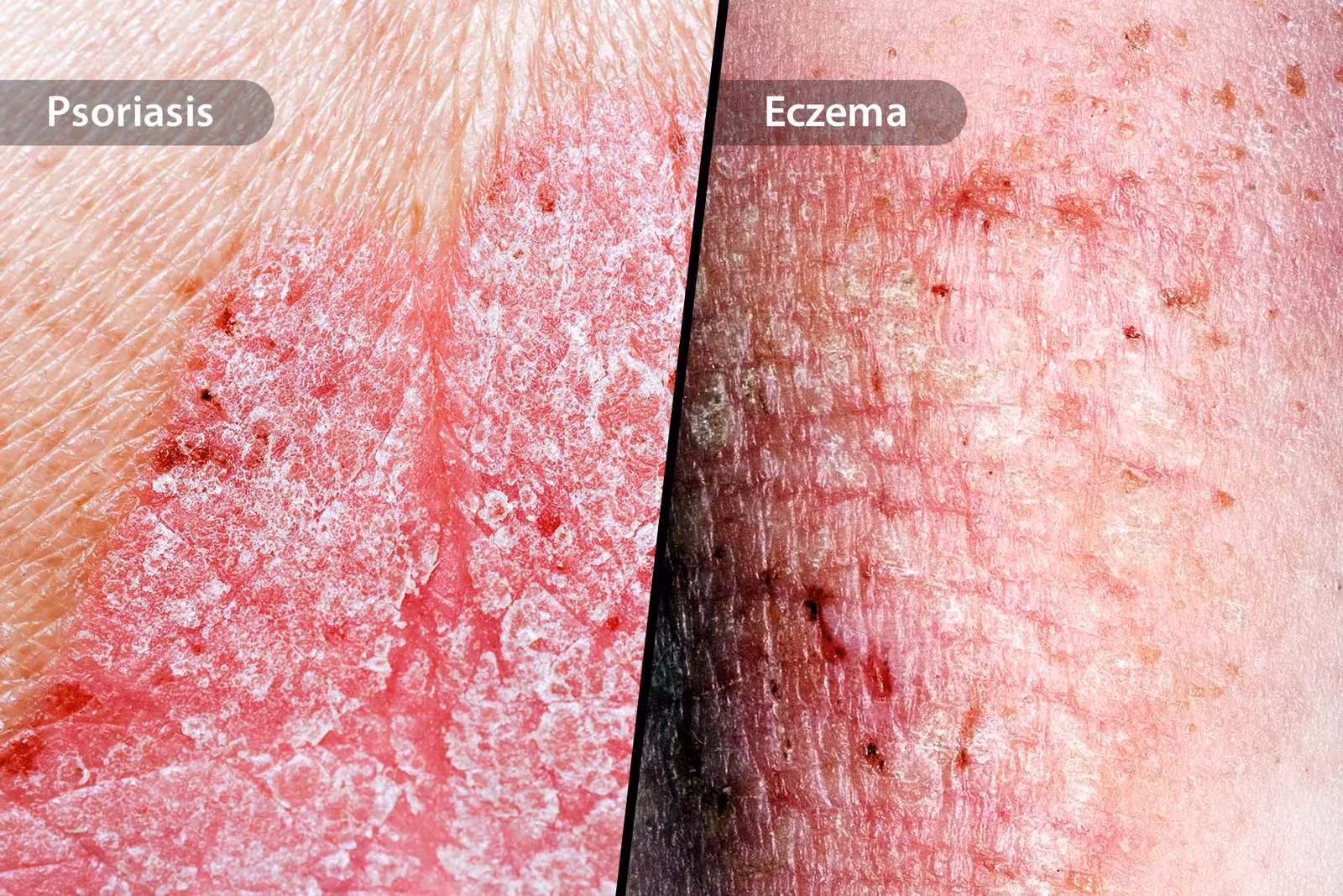 Eczema & Psoriasis