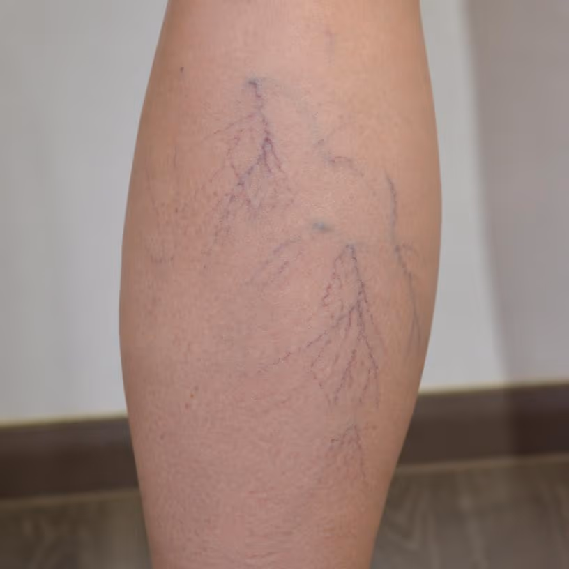 Spider Veins & Varicose Veins