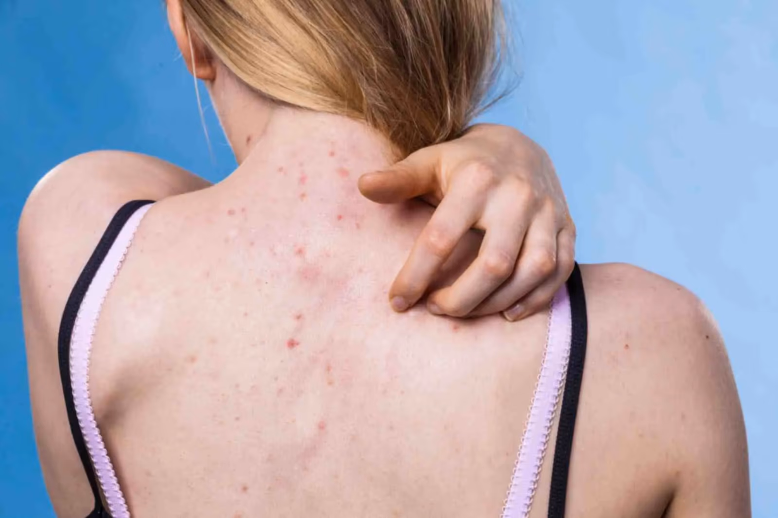 Back Acne Treatment