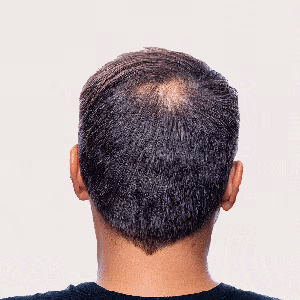 Tackle Bald Patches