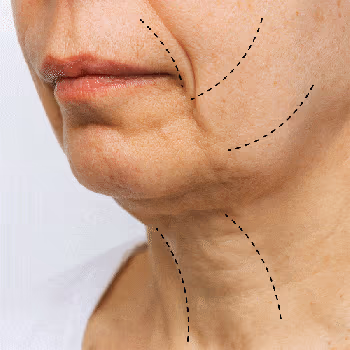 Skin Tightening