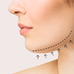 Visible Tightening and Firming