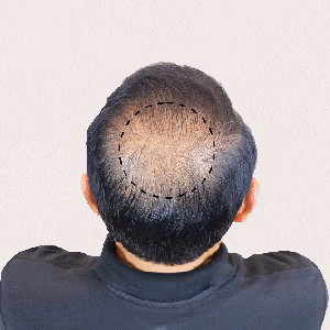 Restores Hair