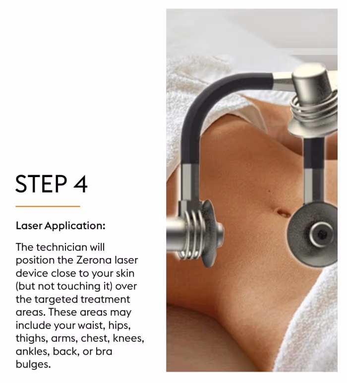 Fat Loss Zerona Laser Treatment 6