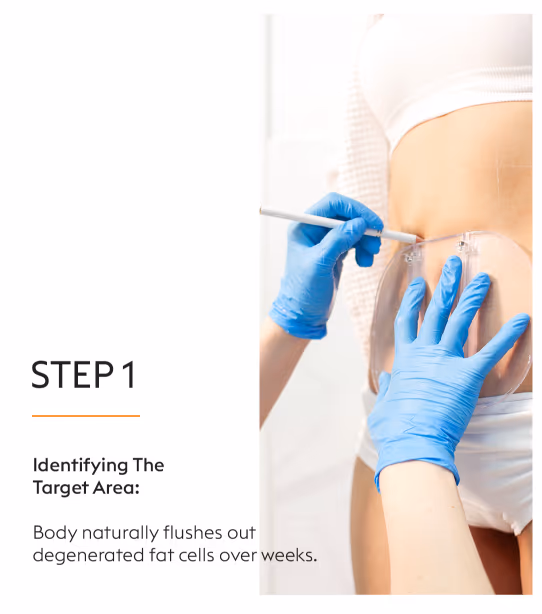 Coolsculpting Fat Loss Treatment 5