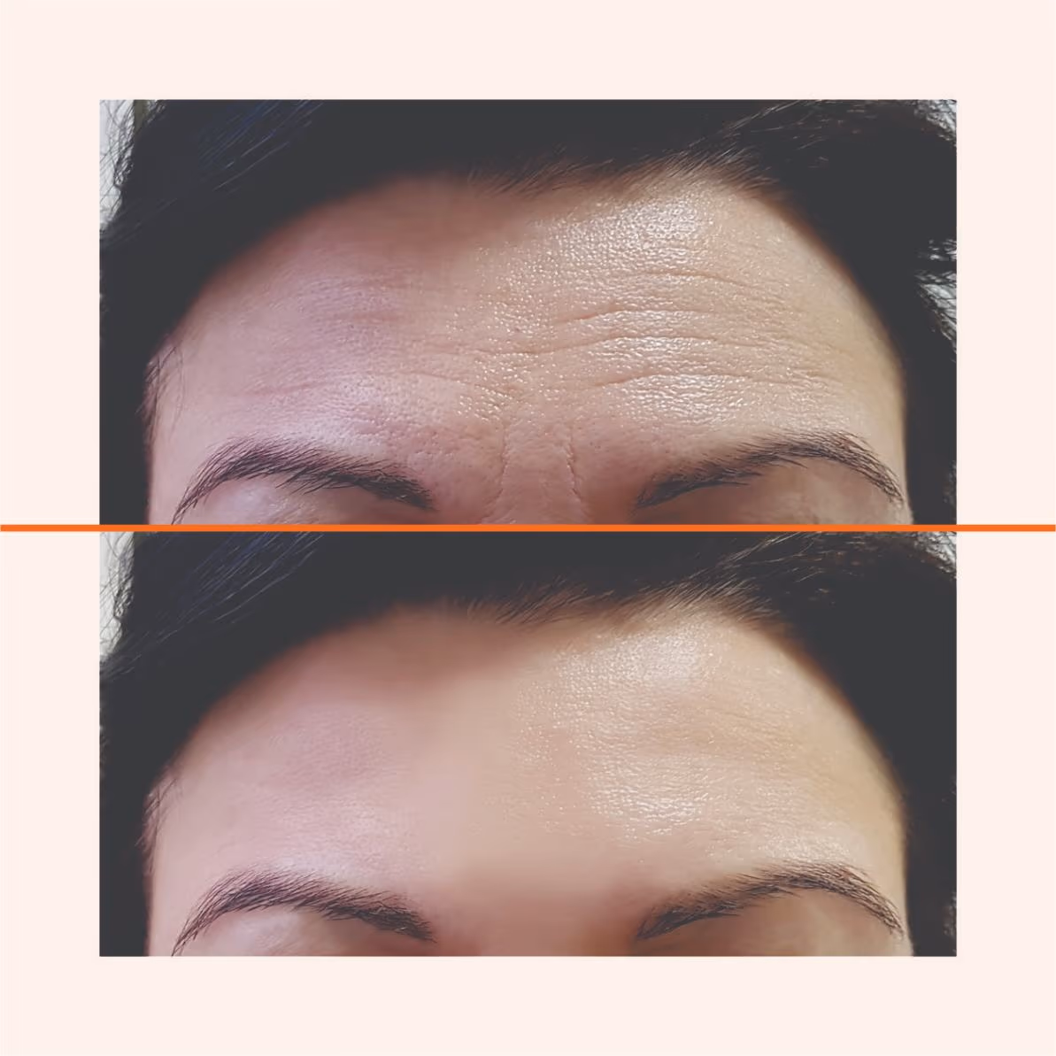 Botox 1