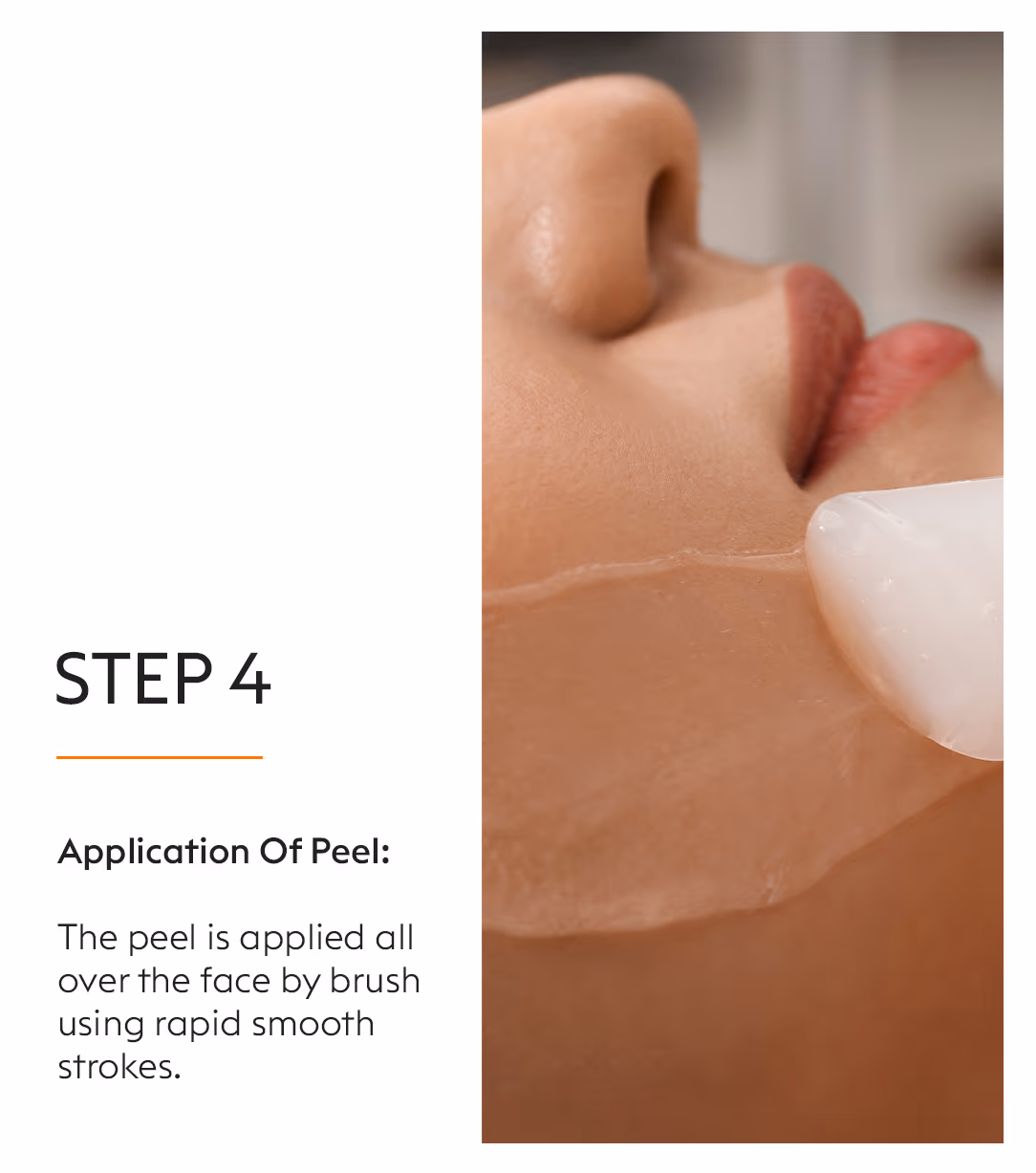 Chemical Peels Acne Scars Treatment 9