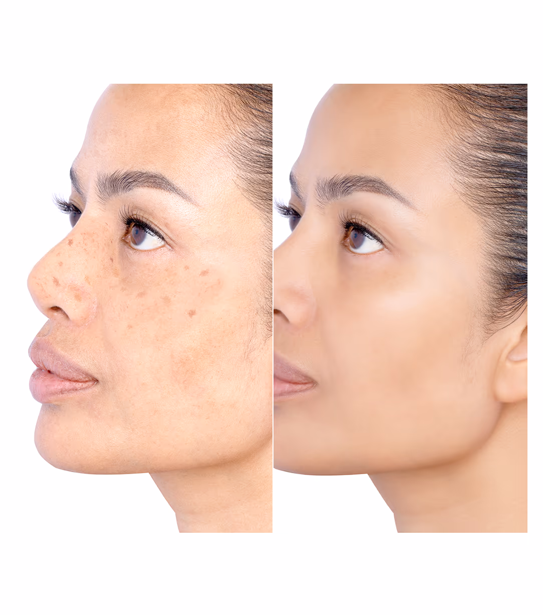 Inno Peel / Mango Peel Skin Whitening Treatment 1