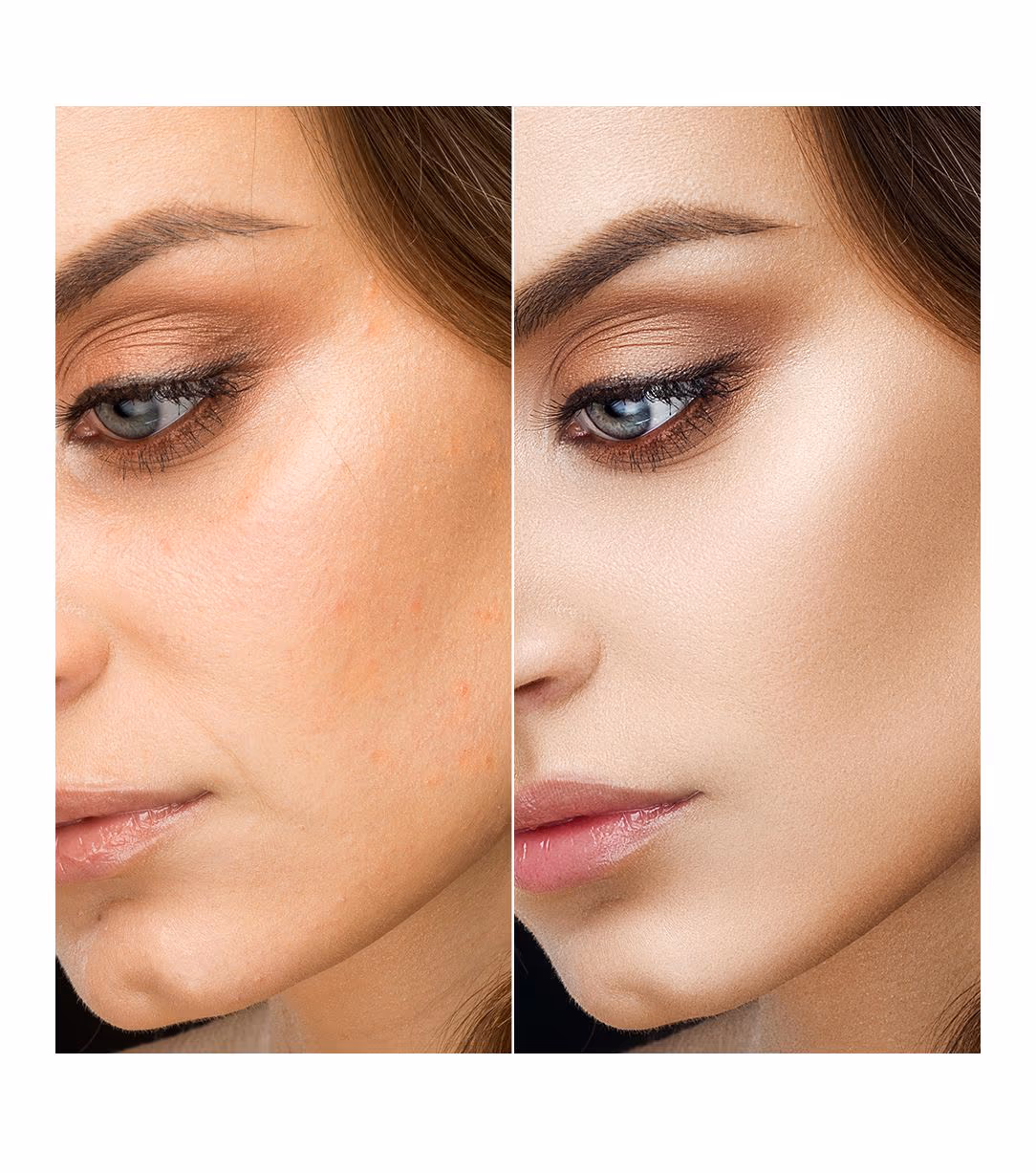 HA Skin Boosters 1