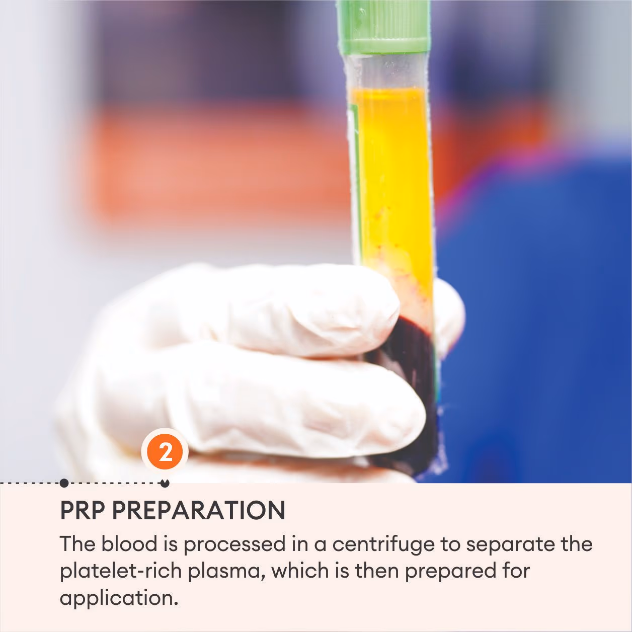 Face PRP 4