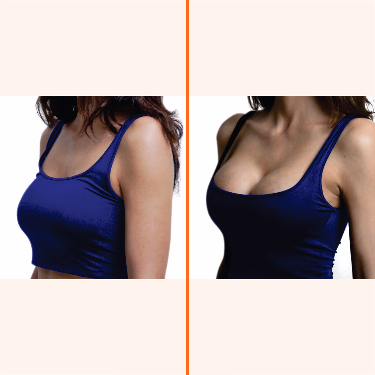 Breast Augmentation (Mammoplasty) 2