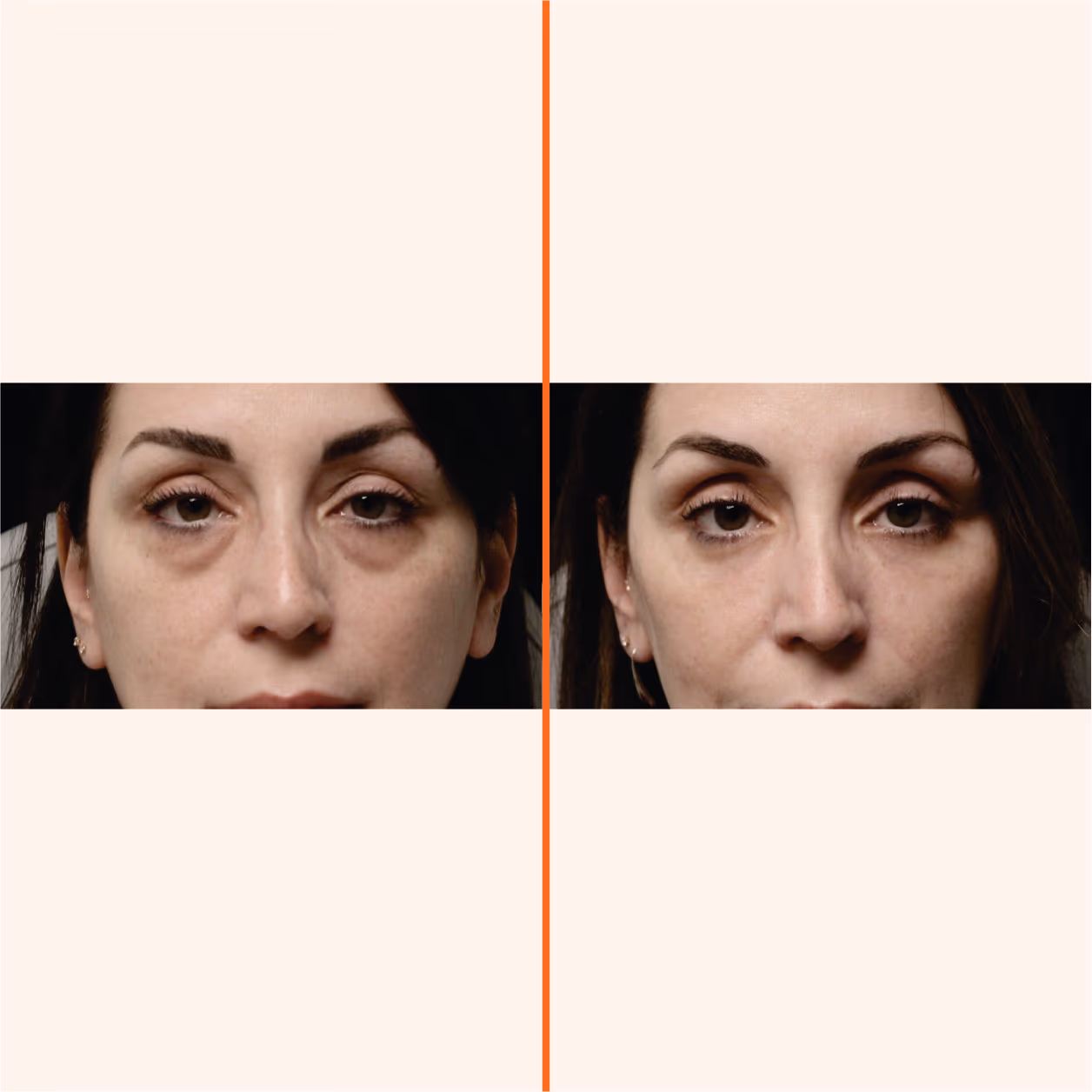 Dermafrac Skin Infusion 2