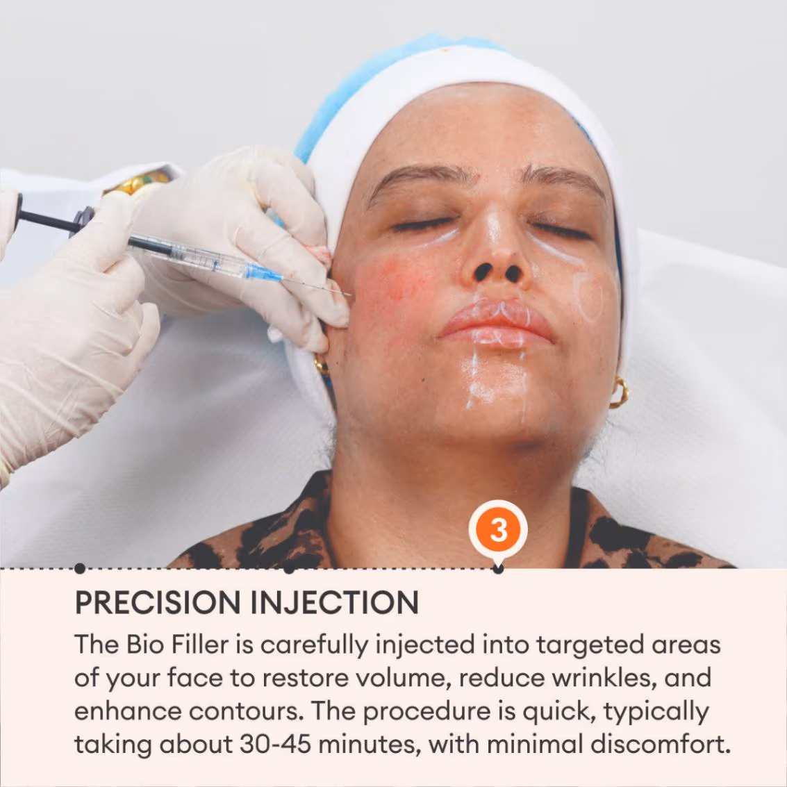 Bio Filler 5