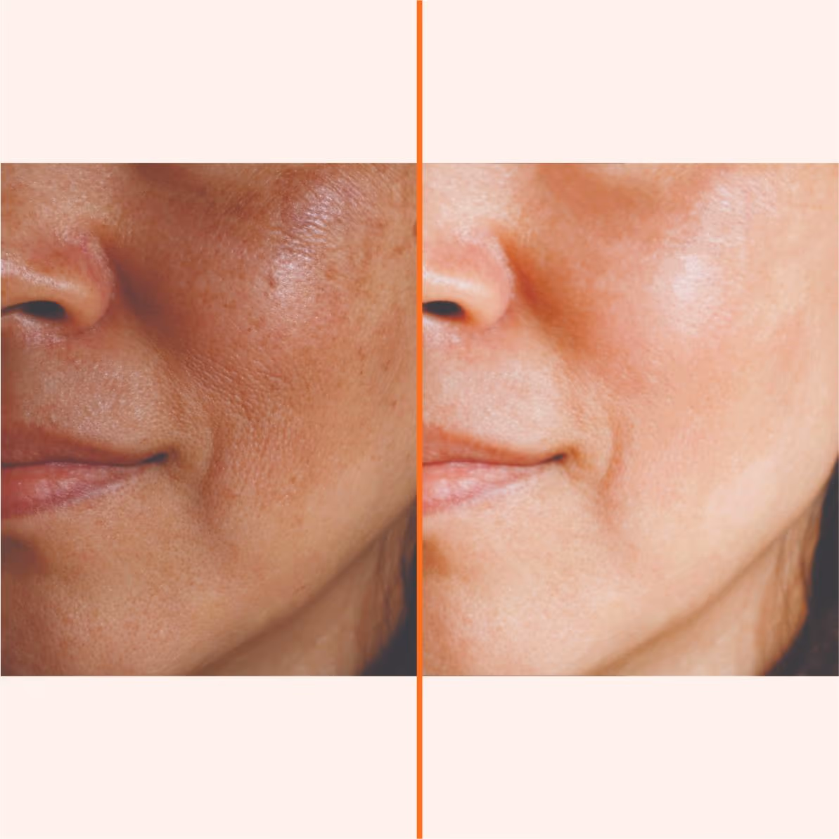 Hydrafacial 1