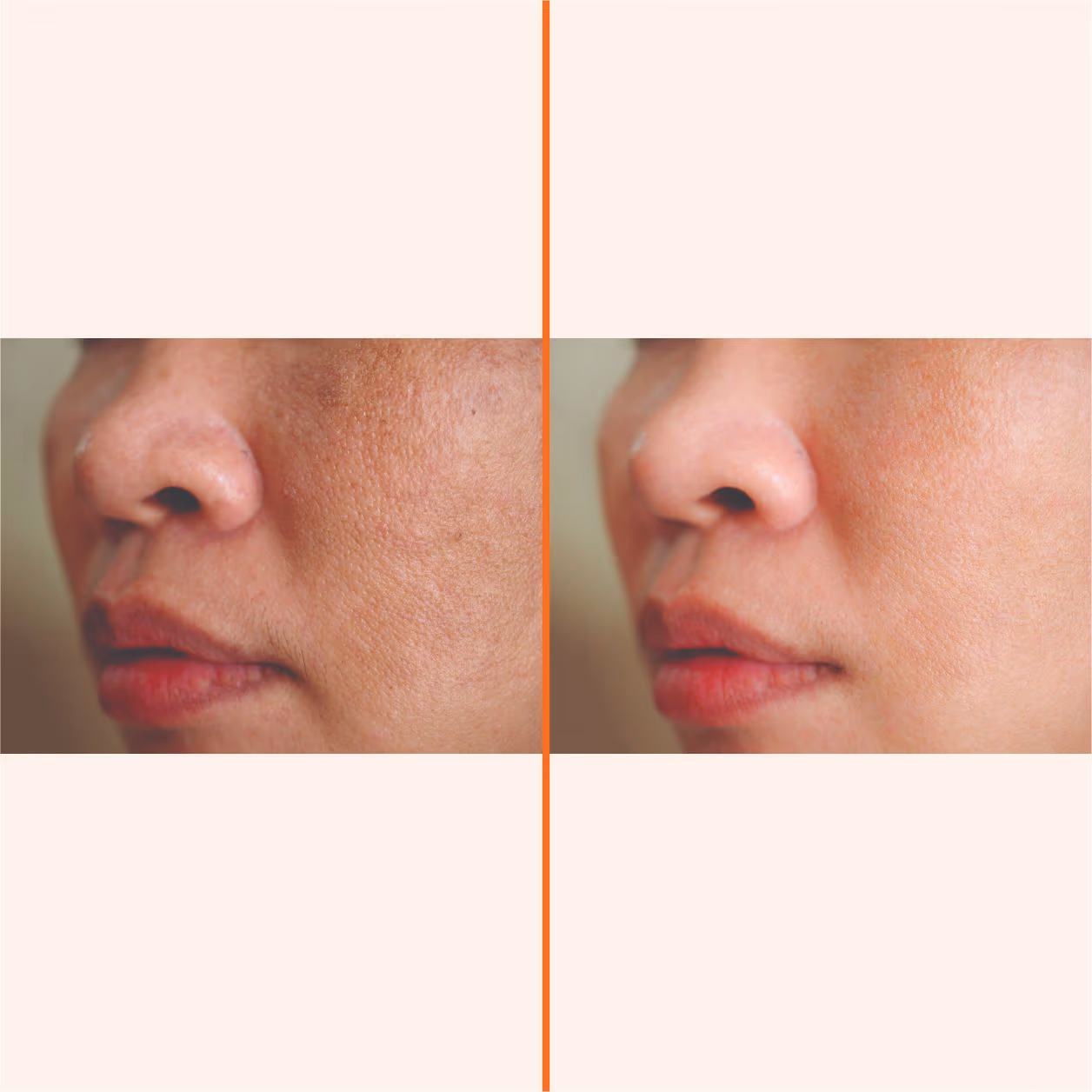 Face PRP 1