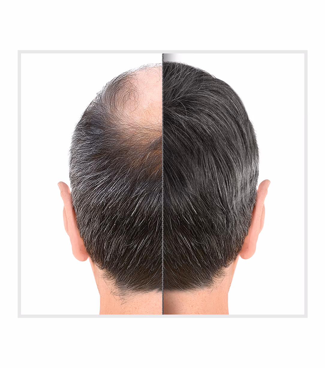 Hair Transplant Hair Fall Treatment 1