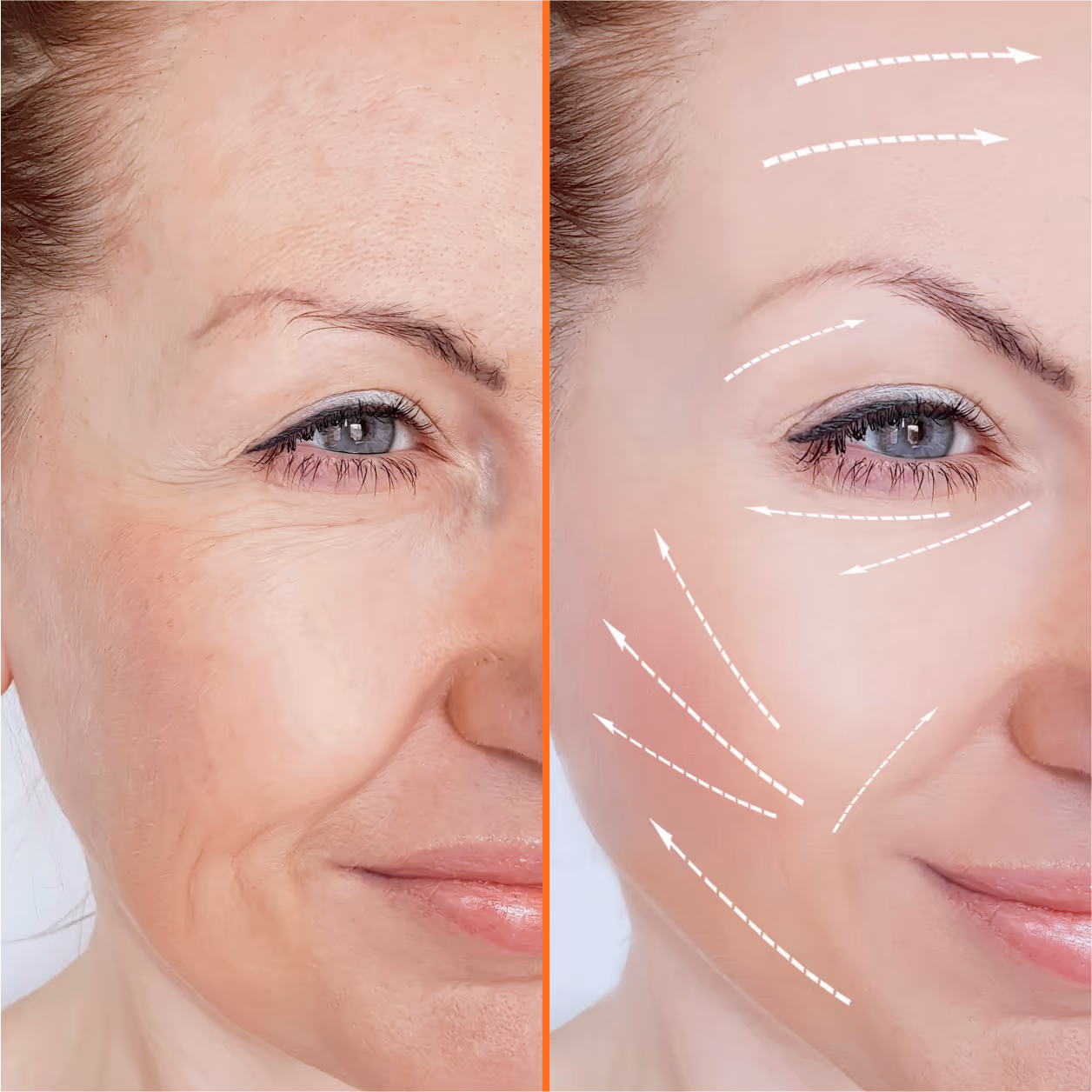 Face Lift Surgery 2