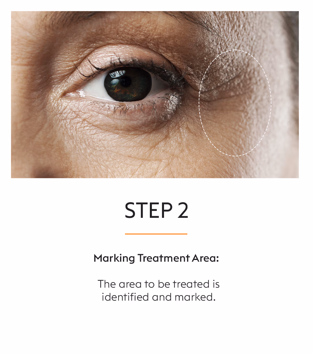Hifu Facial Skin Tightening Treatment 4