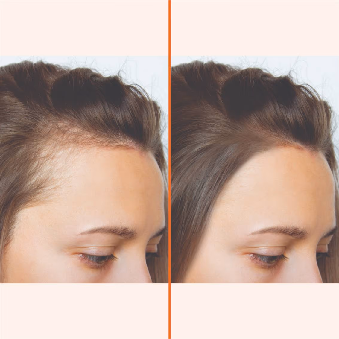 Hair PRP 1