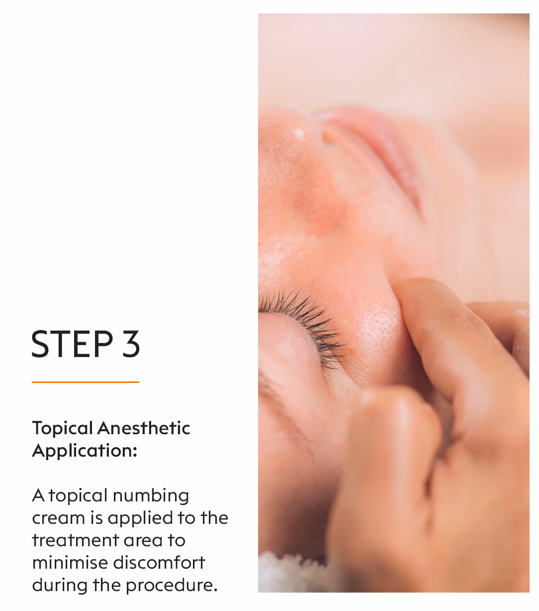 Dermapen Microneedling Treatment 5