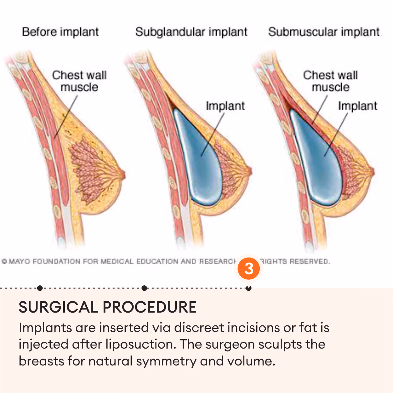 Breast Augmentation (Mammoplasty) 6
